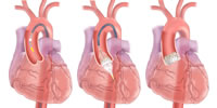 Transcatheter Valvular Procedure Code Set Updates